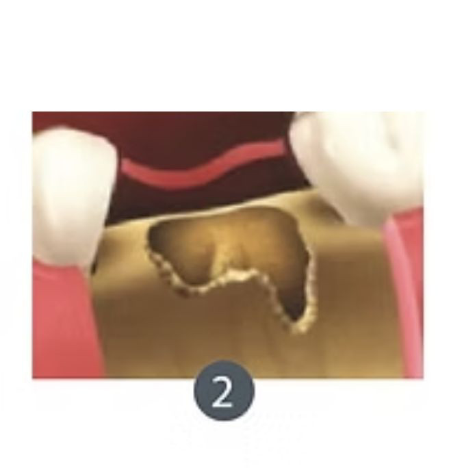 exodoncia_completa2