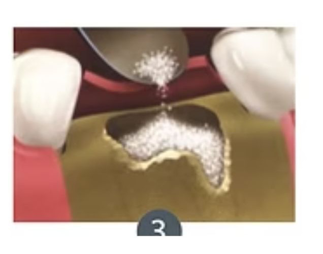 exodoncia_completa3