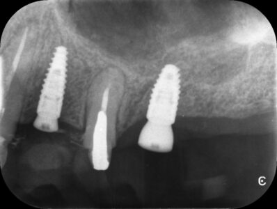 implante5