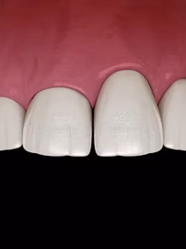 gingivectomia_wix